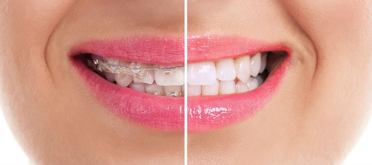 Зачем нужны брекеты на зубах? В чем состоят их преимущества