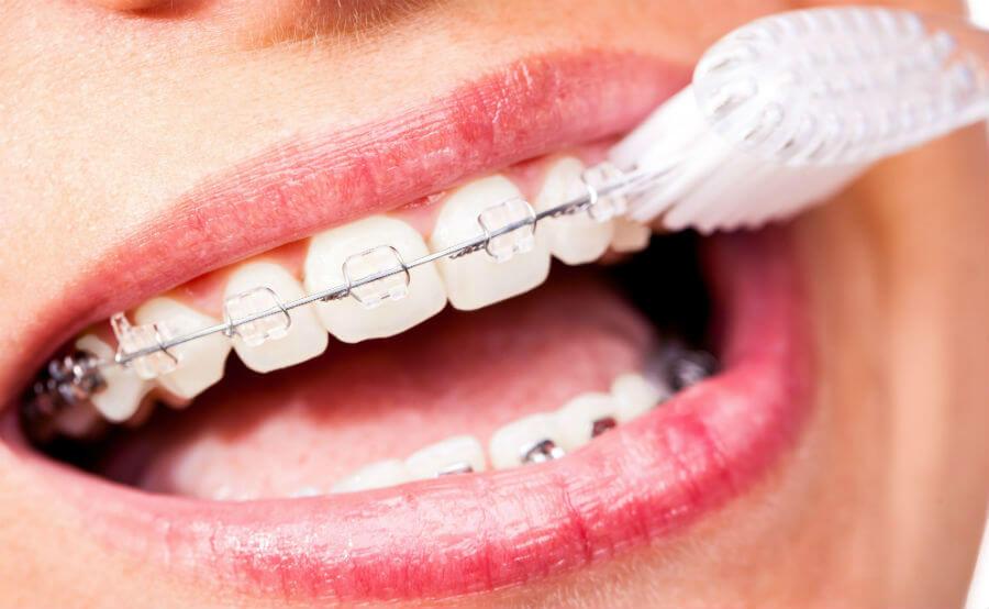 Зачем нужны брекеты на зубах? В чем состоят их преимущества